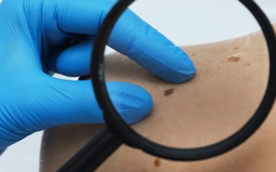 Il melanoma: cosa è e come si previene