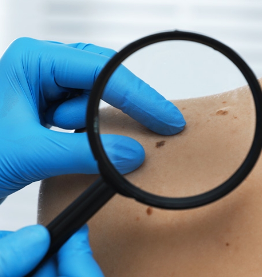 Il melanoma: cosa è e come si previene